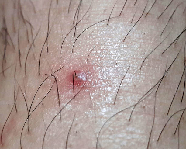 Close-up of folliculitis infection on skin: Causes, symptoms, and treatment options